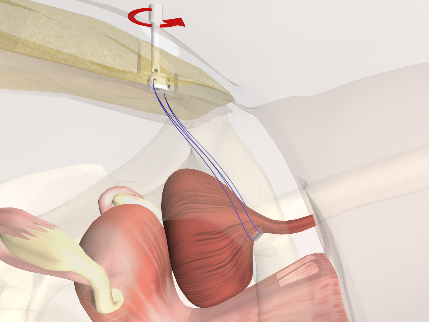 Urinary Incontinence Surgeries (Remeex)